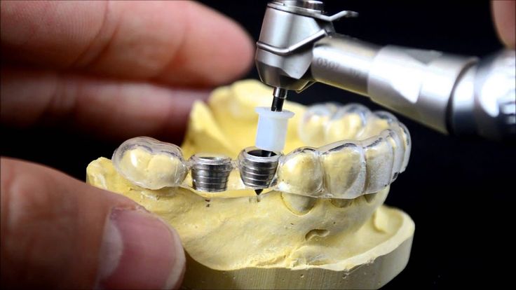 Latest Dental Implant Technology
